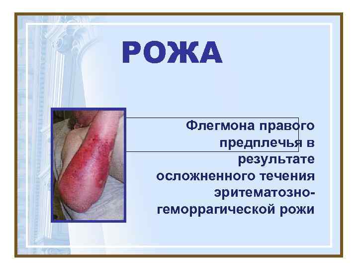 РОЖА  Флегмона правого   предплечья в  результате осложненного течения  