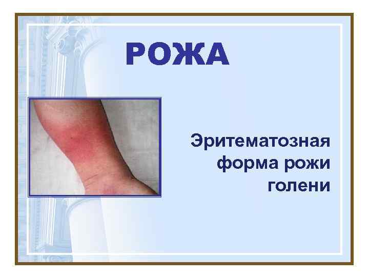 РОЖА  Эритематозная форма рожи   голени 