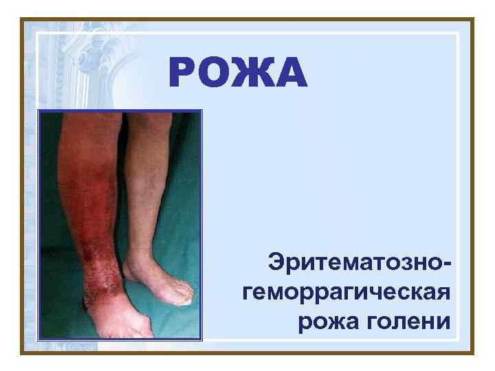 РОЖА  Эритематозно-  геморрагическая  рожа голени 