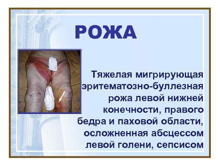 РОЖА Тяжелая мигрирующая эритематозно-буллезная  рожа левой нижней конечности, правого бедра и паховой области,