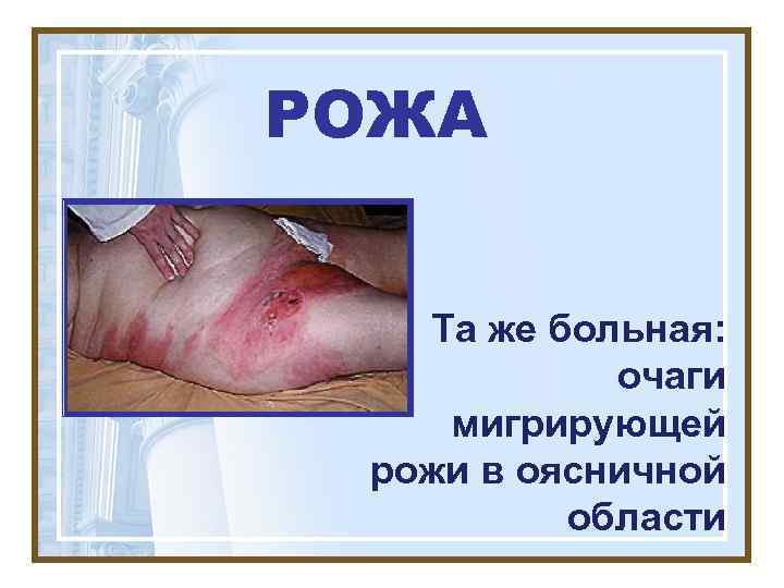 РОЖА Та же больная:   очаги мигрирующей рожи в оясничной  области 