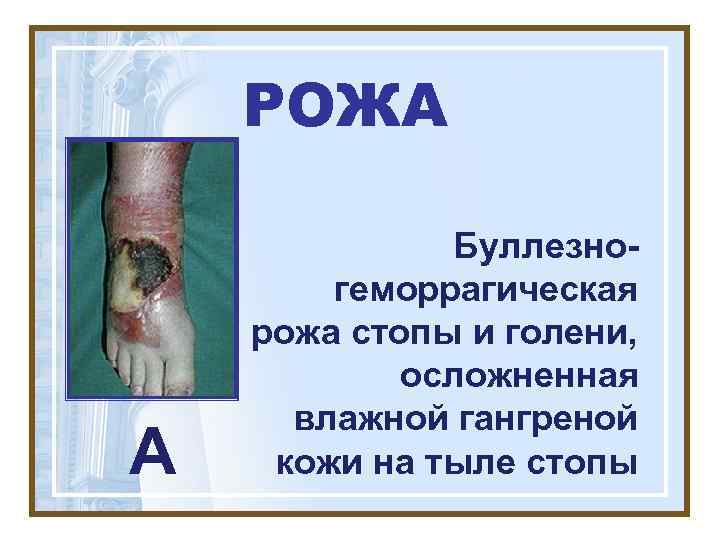   РОЖА    Буллезно-   геморрагическая рожа стопы и голени,