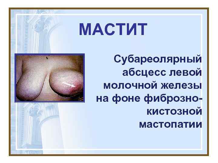 МАСТИТ Субареолярный абсцесс левой  молочной железы на фоне фиброзно-   кистозной 