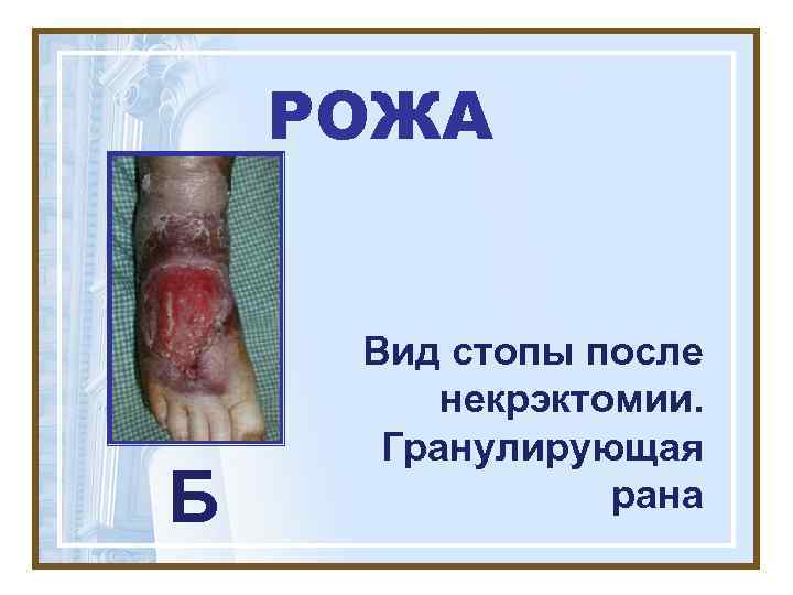   РОЖА  Вид стопы после   некрэктомии.  Гранулирующая Б 