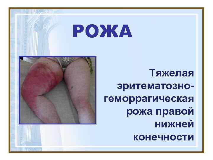 РОЖА  Тяжелая эритематозно-  геморрагическая  рожа правой  нижней  конечности 