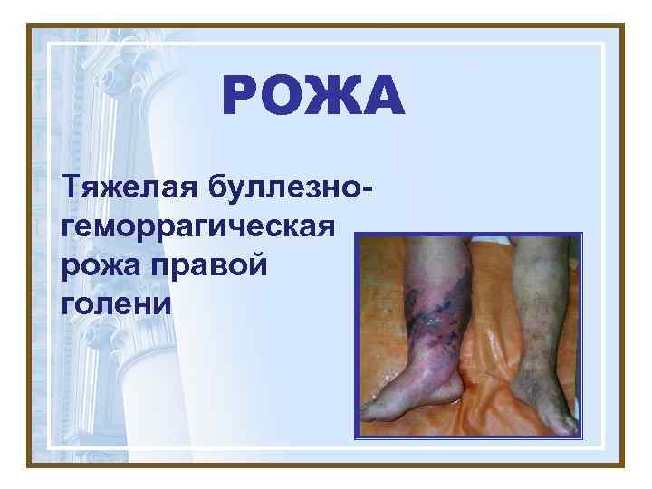   РОЖА Тяжелая буллезно- геморрагическая рожа правой голени 