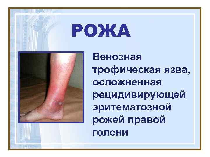 РОЖА Венозная трофическая язва,  осложненная рецидивирующей эритематозной рожей правой голени 