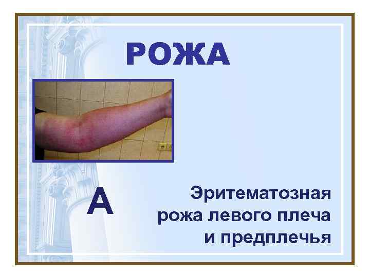   РОЖА  А  Эритематозная рожа левого плеча   и предплечья