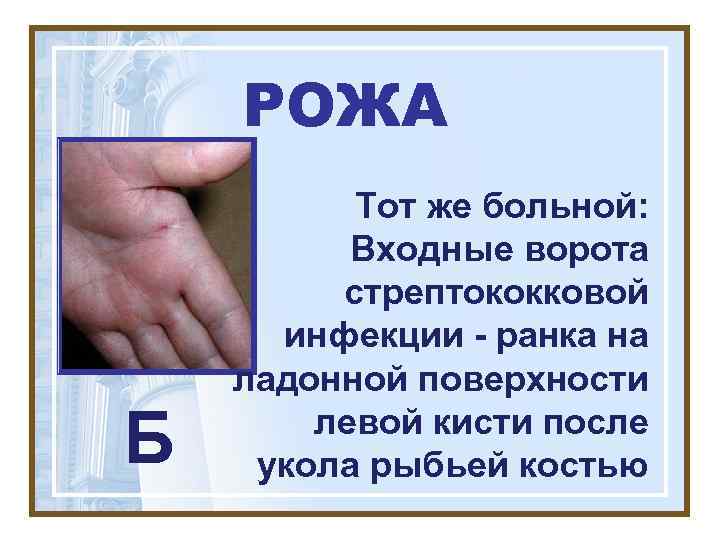   РОЖА  Тот же больной:  Входные ворота   стрептококковой 