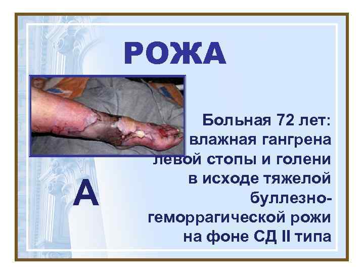   РОЖА   Больная 72 лет:  влажная гангрена левой стопы и