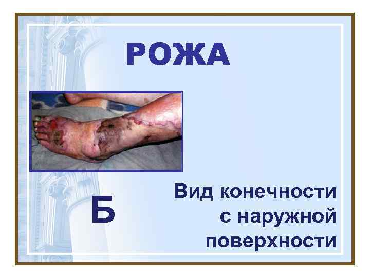   РОЖА   Вид конечности Б  с наружной  поверхности 