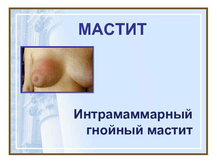 МАСТИТ Интрамаммарный гнойный мастит 