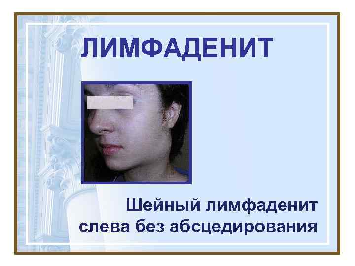 ЛИМФАДЕНИТ   Шейный лимфаденит слева без абсцедирования 