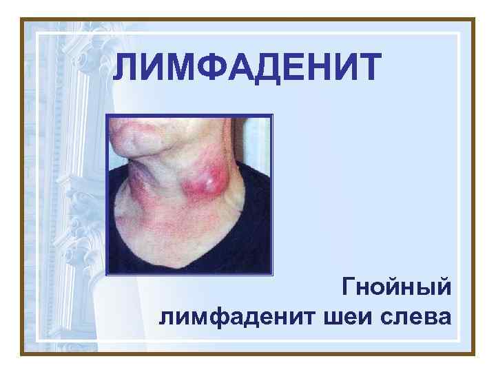 ЛИМФАДЕНИТ   Гнойный лимфаденит шеи слева 