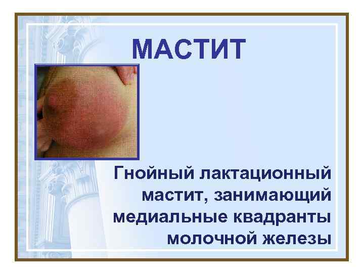  МАСТИТ  Гнойный лактационный  мастит, занимающий медиальные квадранты молочной железы 