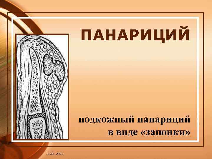    ПАНАРИЦИЙ   подкожный панариций    в виде «запонки»