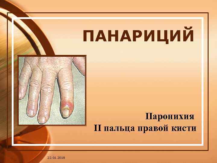   ПАНАРИЦИЙ     Паронихия   II пальца правой