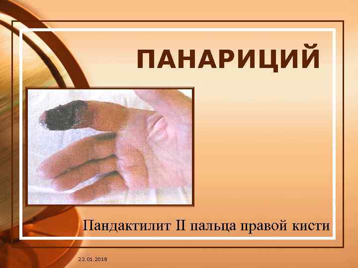    ПАНАРИЦИЙ Пандактилит II пальца правой кисти 22. 01. 2018 