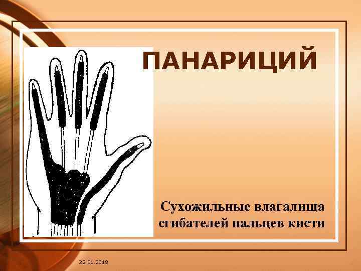    ПАНАРИЦИЙ   Сухожильные влагалища   сгибателей пальцев кисти 22.