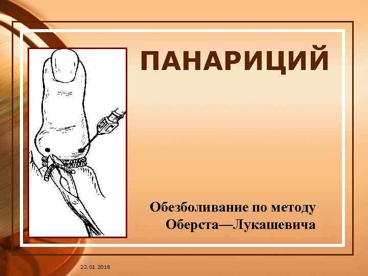    ПАНАРИЦИЙ   Обезболивание по методу    Оберста—Лукашевича 22.