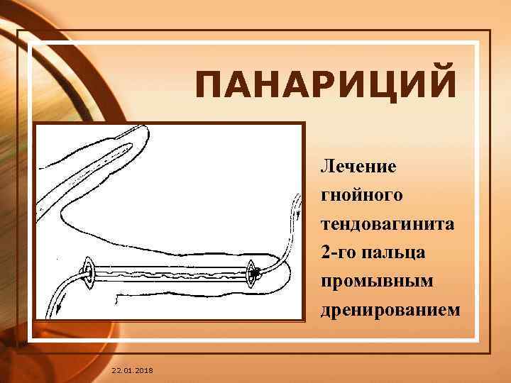    ПАНАРИЦИЙ    Лечение   гнойного   тендовагинита