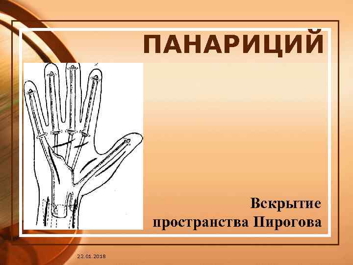    ПАНАРИЦИЙ     Вскрытие   пространства Пирогова 22.