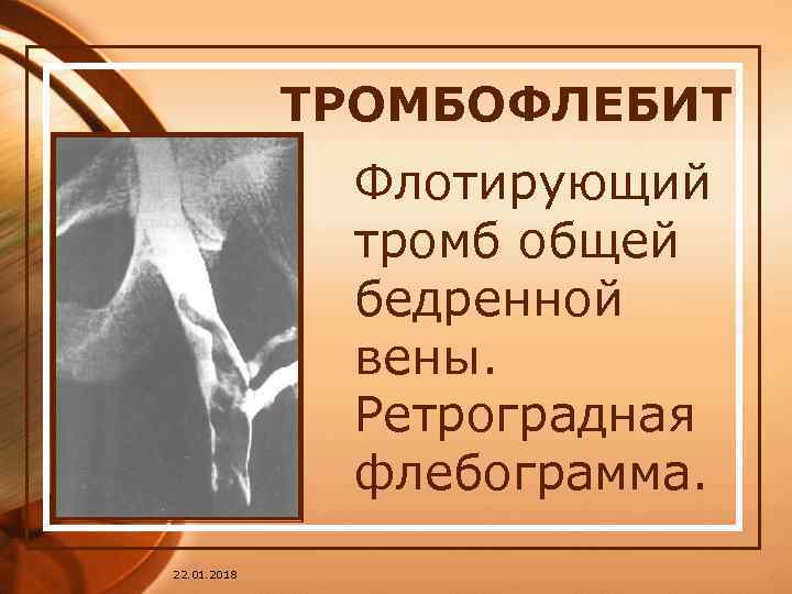    ТРОМБОФЛЕБИТ    Флотирующий    тромб общей 