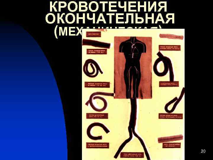 КРОВОТЕЧЕНИЯ ОКОНЧАТЕЛЬНАЯ (МЕХАНИЧЕСКАЯ)    20 