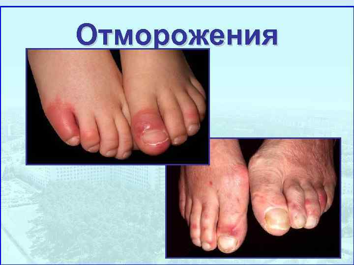 Отморожения 