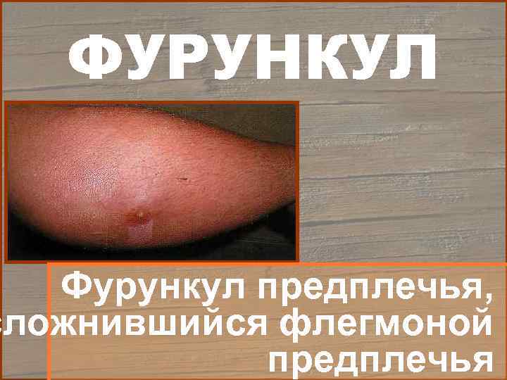   ФУРУНКУЛ Фурункул предплечья, сложнившийся флегмоной   предплечья 