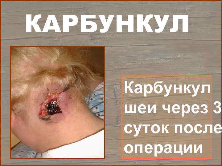 КАРБУНКУЛ  Карбункул шеи через 3 суток после операции 