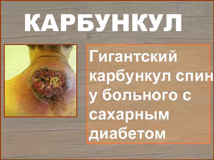 КАРБУНКУЛ  Гигантский  карбункул спины  у больного с  сахарным  диабетом