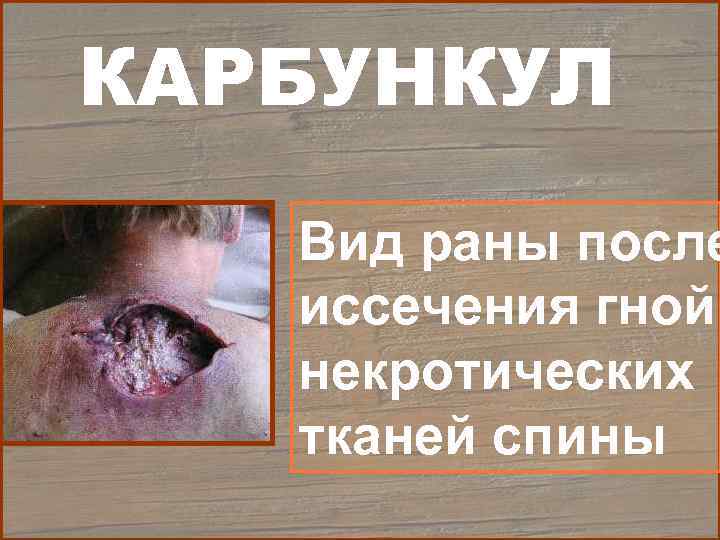 КАРБУНКУЛ  Вид раны после  иссечения гнойн  некротических  тканей спины 