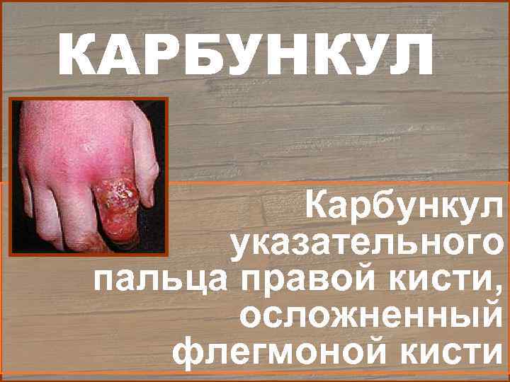 КАРБУНКУЛ  Карбункул  указательного пальца правой кисти,   осложненный  флегмоной кисти