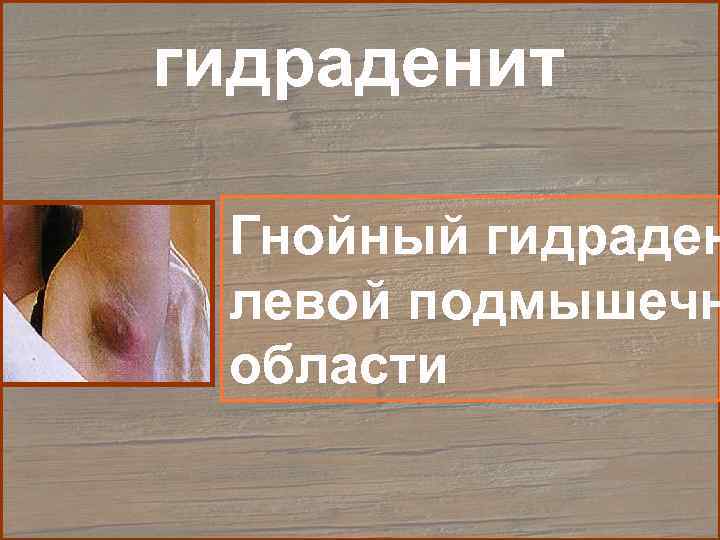 гидраденит  Гнойный гидраден левой подмышечн области 