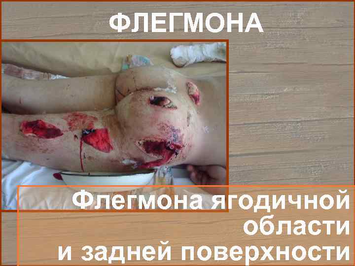   ФЛЕГМОНА Флегмона ягодичной   области и задней поверхности 