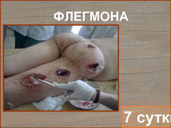 ФЛЕГМОНА  7 сутки 