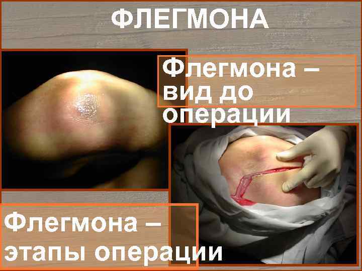  ФЛЕГМОНА  Флегмона –  вид до  операции  Флегмона – этапы