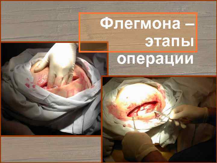 Флегмона – этапы операции 