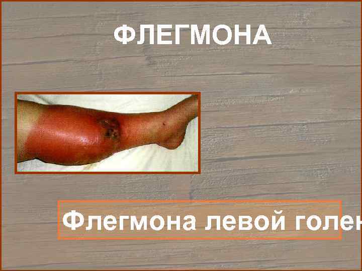   ФЛЕГМОНА Флегмона левой голен 