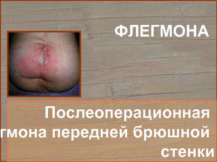   ФЛЕГМОНА   Послеоперационная гмона передней брюшной    стенки 