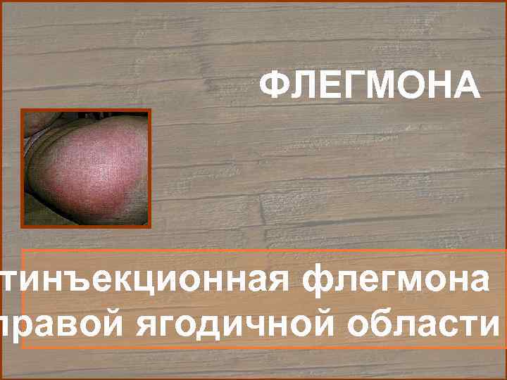   ФЛЕГМОНА тинъекционная флегмона правой ягодичной области 