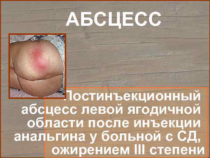   АБСЦЕСС   Постинъекционный абсцесс левой ягодичной  области после инъекции анальгина