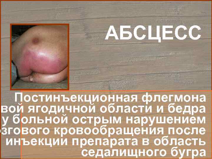     АБСЦЕСС Постинъекционная флегмона евой ягодичной области и бедра у больной
