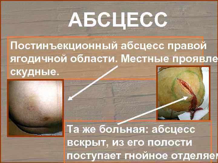    АБСЦЕСС Постинъекционный абсцесс правой ягодичной области. Местные проявле скудные.  