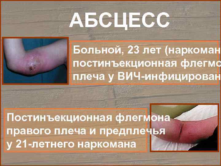    АБСЦЕСС  Больной, 23 лет (наркомани  постинъекционная флегмо  плеча