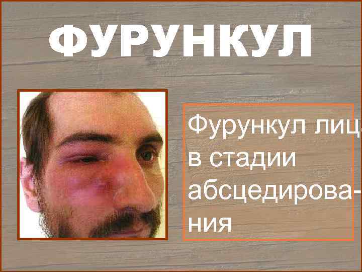 ФУРУНКУЛ Фурункул лица в стадии абсцедирова- ния 