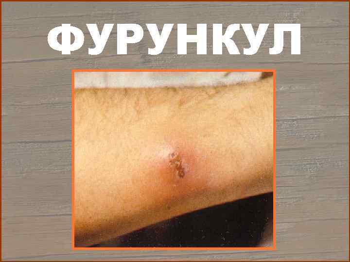 ФУРУНКУЛ 