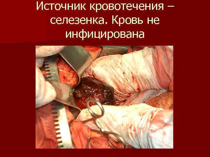 Источник кровотечения –  селезенка. Кровь не инфицирована 