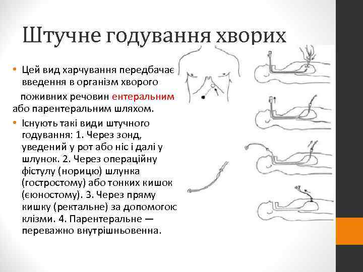  Штучне годування хворих • Цей вид харчування передбачає  введення в організм хворого